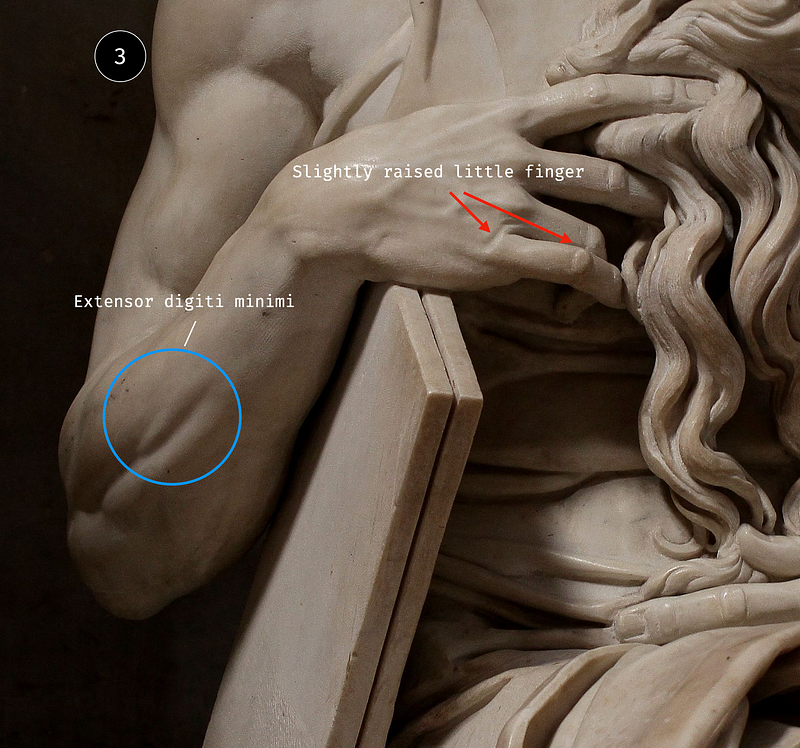Muscle ripple at the root of the little finger and an elevated extensor digiti minimi